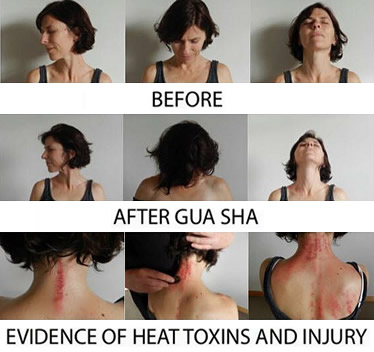 Gua Sha before and after examples
