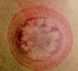 Pic 1: A mottled cupping mark indicating insufficient strength (paleness) and sluggish circulation producing mild blood stasis (crimson/purple). When this evidence is noted, flash cupping performed by rapid on and off applications revives energy and moves the blood. It is a soothing and tonifying method that restores the integrity to soft tissue and removes dull or intermittent pain and feelings of weakness.
