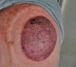Pic 2: This very defined cupping mark is located above a medically diagnosed partially torn middle deltoid muscle injured nine months before this photo was taken. It identifies blood stagnation and features a proliferation of black, slightly elevated blood clots and swelling, reflecting deep, sharp persistent pain and immobility.