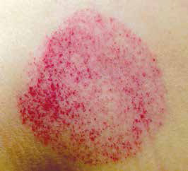 Pic 3: Small red dotting indicates the release of heat toxins (sha).