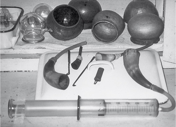 An assortment of cupping instruments used at the Tibetan Traditional Medical Hospital in Lhasa. Five bronze cupping vessels are shown at the top while resting on the tray are different sized yak horn cups with tubes attached to allow the air inside to be drawn out by the large clear pump at the foot of the picture. Also on the tray are two metal scarifiers used to nick the skin or vein for wet cupping.