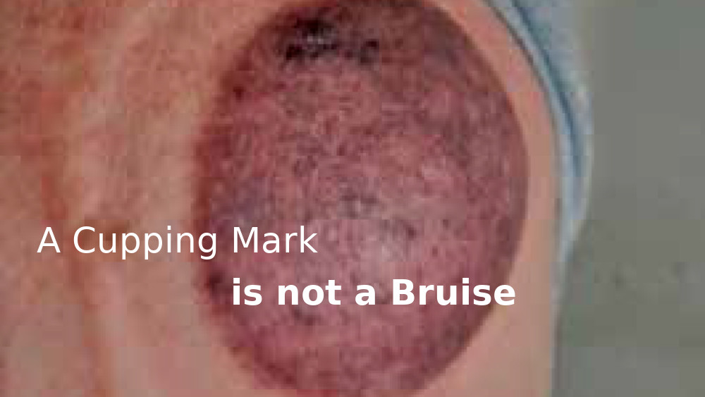 A Cupping Mark Is Not A Bruise
