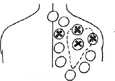 Soula Tzabana's cupping treatment