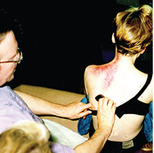 Bruce performing gua sha on a woman who suffers chronic neck and shoulder pain after a skiing accident six years before. Immediately after treatment she reported her mobility had increased and the pain was much diminished.