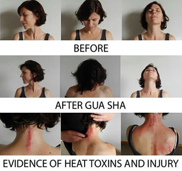 gua sha training