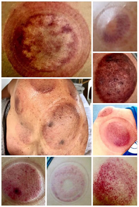 Examples of cupping marks